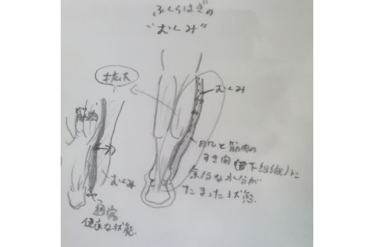 むくみ図イメージ